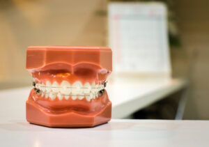 The Benefits of Damon Braces at South Meadows Dental & Orthodontics in Reno, NV